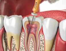 Formation continue en endodontie dans un cabinet moderne